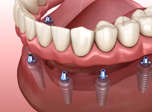 implant-supported dentures