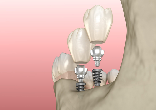 virtual model of mini implants 